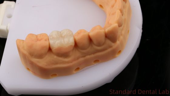 Translucence Zirconia Dental Inlay Onlay Crown Untuk Memulihkan Bentuk Ruang Alam / Laboratorium Gigi Standar