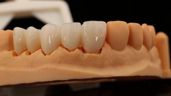 Gigi Bagian Depan Yang Sangat Estetis Full Contour Zirconia Crown dengan Laboratorium Gigi Vita Shade