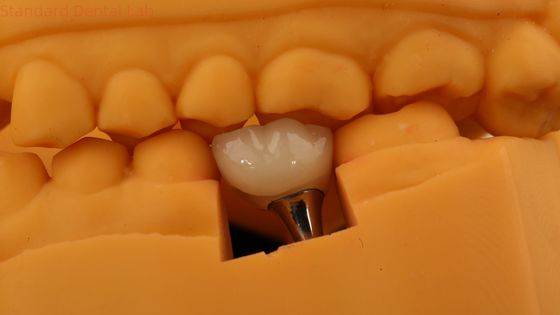 Tulang Pengikat Implantasi Gigi Crown Dental PFM Crown Dengan Model Cetak 3D
