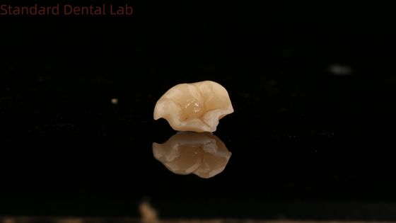 Kekuatan Emax Keramik Mahkota Gigi Onlay dengan ketahanan noda yang sangat baik China Dental Lab