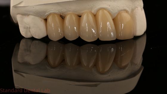 Noritake Porselin Full Contour Zirconia Crown High Aesthetic Natural Customized Zirconia Dental Bridge