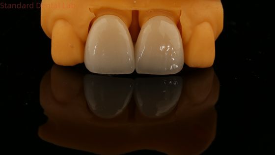 5 Tahun Garansi Full Contour Zirconia Crown Disesuaikan Vita Shade Tinggi Estetika Natural Dental Bridge
