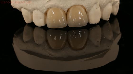 Full Contour Zirconia Crown dan High Aesthetic Natural Dental Bridge Jaminan 5 Tahun