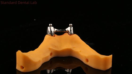 Ivoclar Digital Dental Implant Bar Denture dengan Attachments, Full Acrylic Titanium Implant Supported Dentures