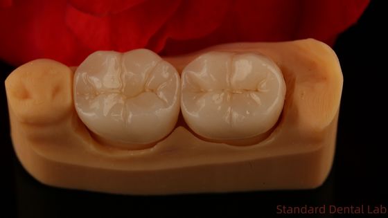 Full Contour Zirconia Crown Kekuatan dan Estetika yang Luar Biasa Tidak Ada Overlay Porselen Corona Belakang Cina Dental Lab