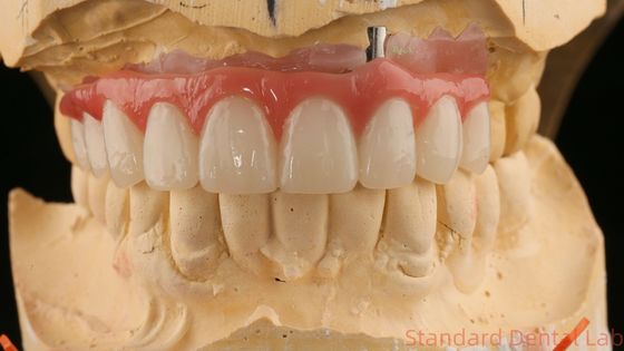 Good Fitting Precise Esthetic Zirconia Porcelain Crown Pink Porcelain Dengan Shade Bleaching